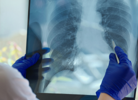 Lung cancer screen program July 2025