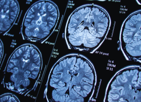 MRI